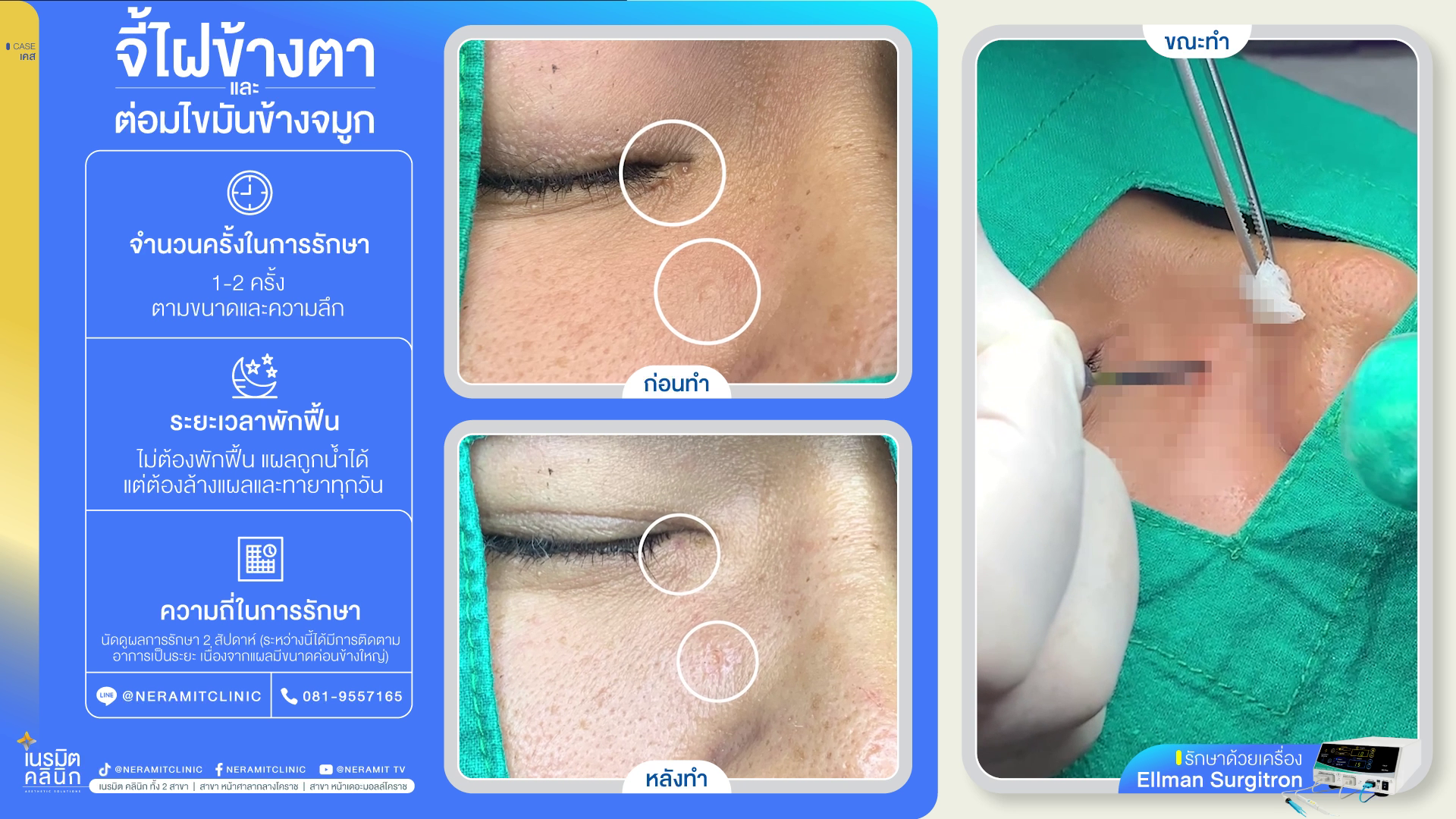 จี้ไฝข้างตา