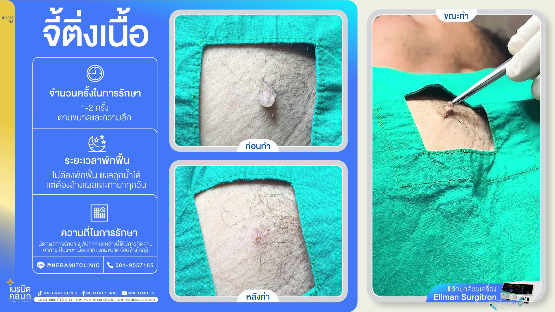 จี้ติ่งเนื้อขนาดใหญ่