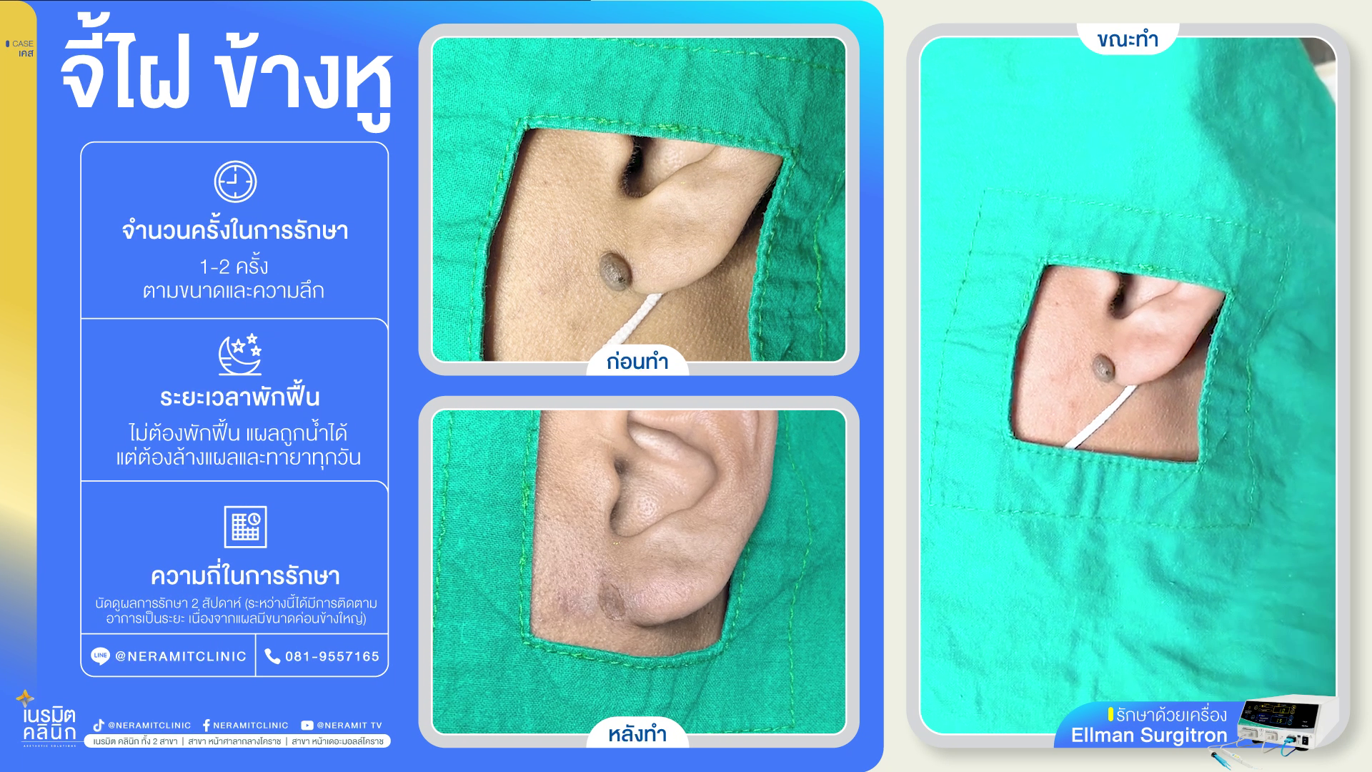 ไฝเม็ดใหญ่ที่หู