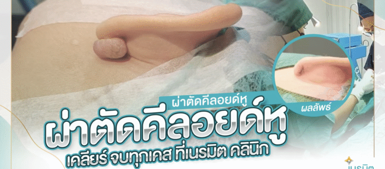 ผ่าตัดแผลคีลอยด์หู