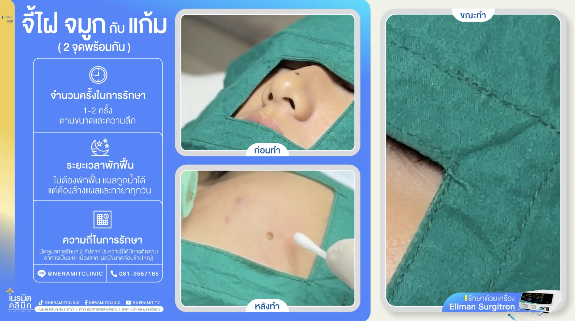 จี้ไฝที่ดั้ง