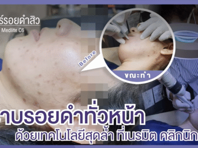 รอยดำสิว