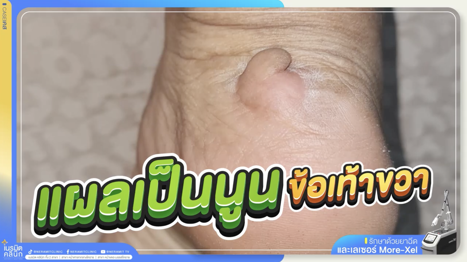 แผลเป็นนูนที่ข้อเท้า