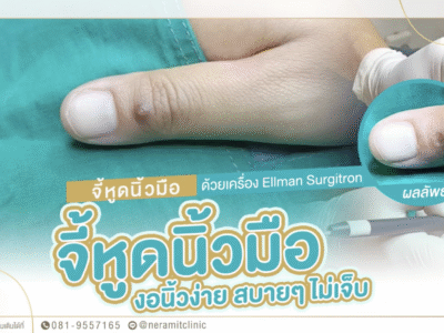 จี้ไฝหูดที่นิ้ว