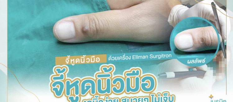 จี้ไฝหูดที่นิ้ว