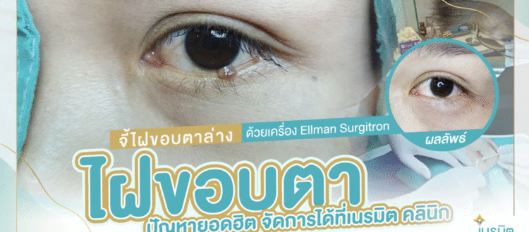 จี้ไฝขอบตาล่าง