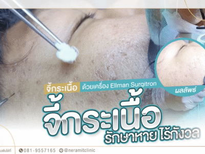 จี้กระเนื้อ