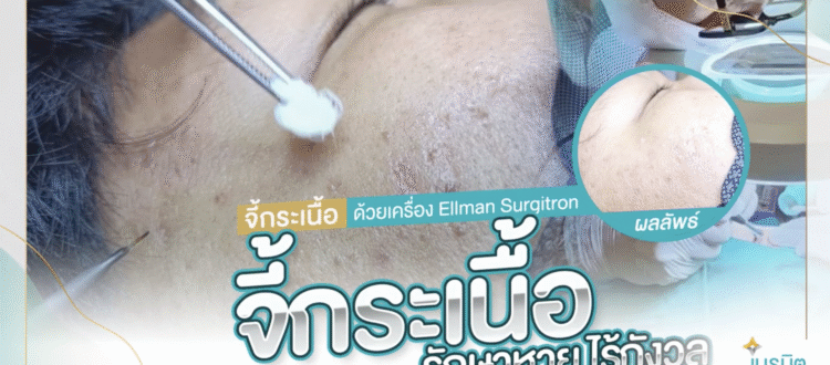 จี้กระเนื้อ