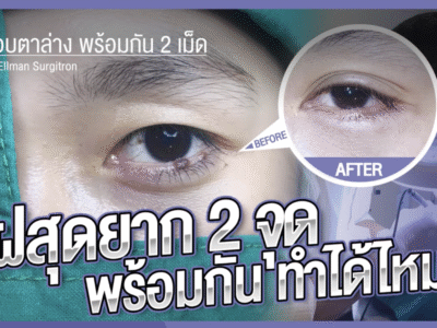 จี้ไฝพร้อมกัน2จุด