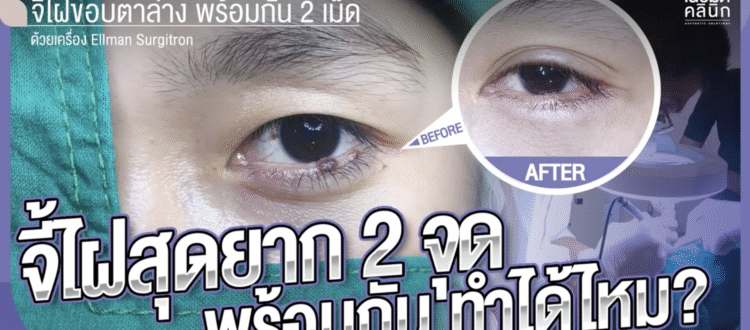 จี้ไฝพร้อมกัน2จุด