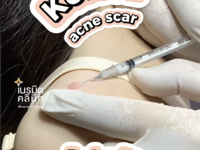 Keloid Acne Scars