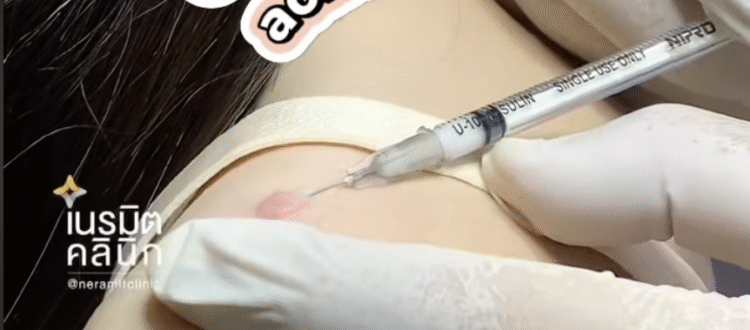 Keloid Acne Scars