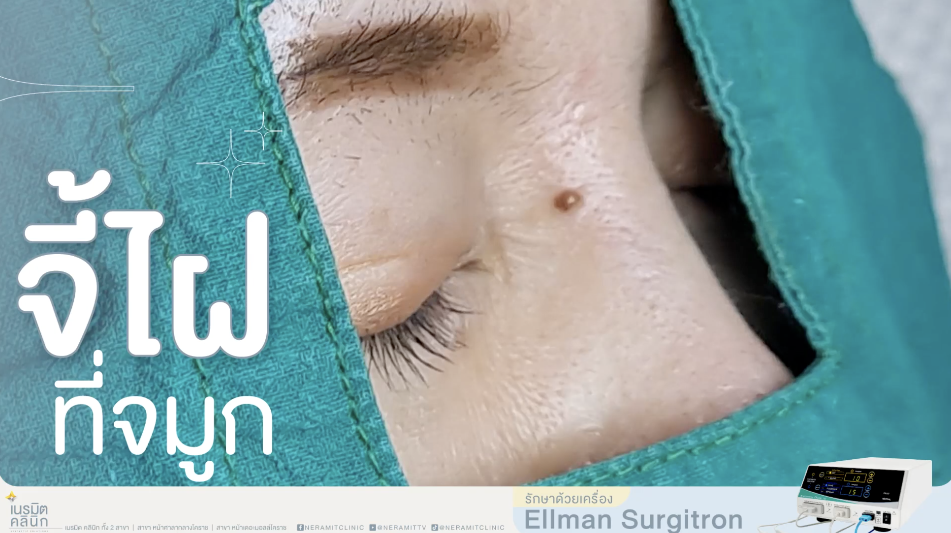 จี้ไฝที่ดั้ง