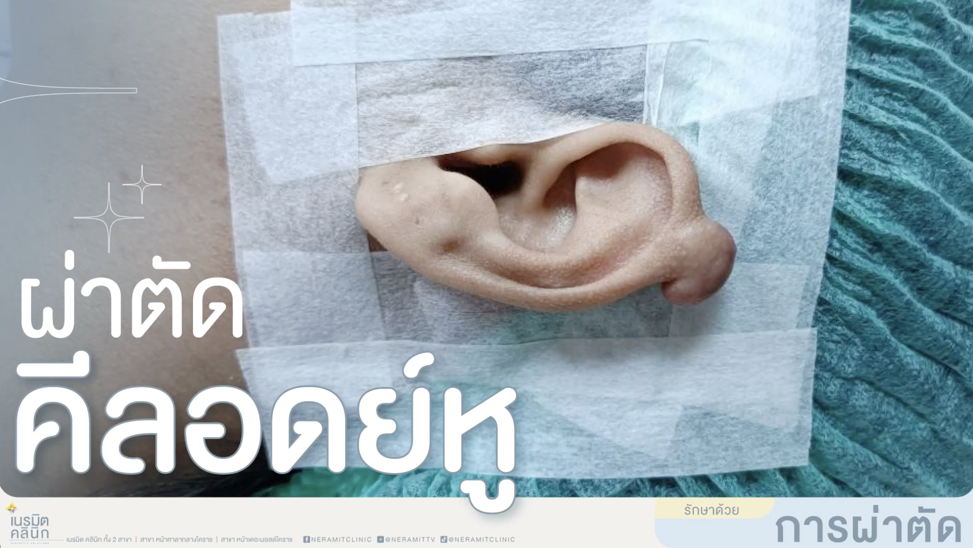 คีลอยด์หูผ่าตัดแล้วกลับมาใหม่ได้ไหม