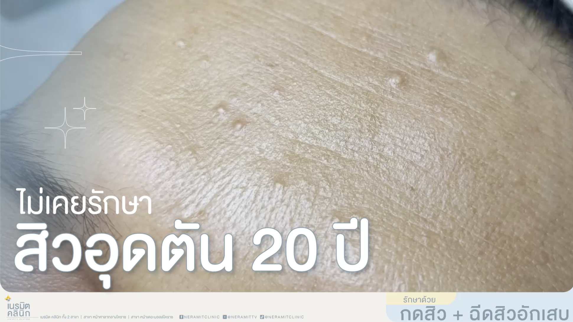 รักษาสิวอุดตัน โคราช กดสิว ฉีดสิวอักเสบ เนรมิตคลินิก