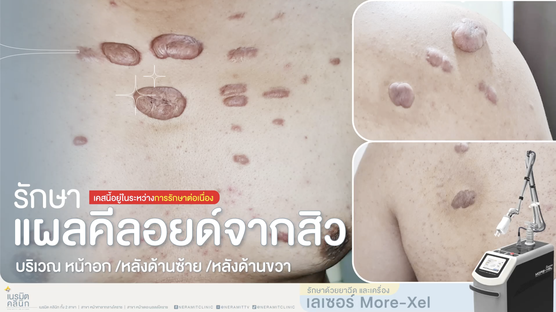 รีวิวรักษาแผลคีลอยด์จากสิวที่หน้าอกและแผ่นหลัง ด้วยยาฉีดและเลเซอร์ More-Xel ที่เนรมิตคลินิก โคราช