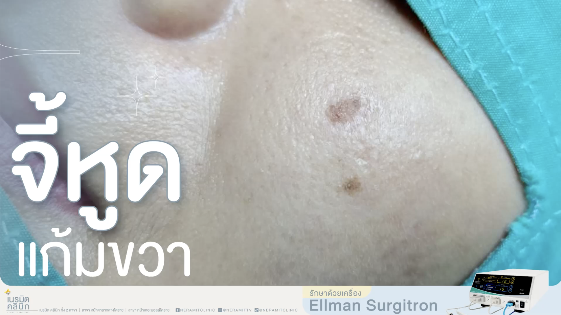 รีวิวการจี้หูดที่แก้มขวา ด้วยเครื่องคลื่นวิทยุ Ellman Surgitron แผลเล็ก ปลอดภัย ที่เนรมิตคลินิก โคราช