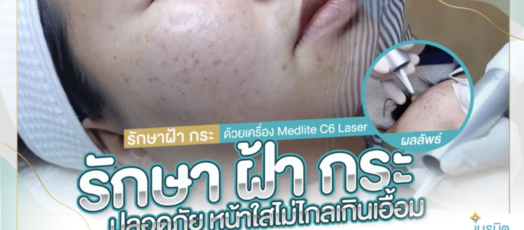 รักษาฝ้ากระ