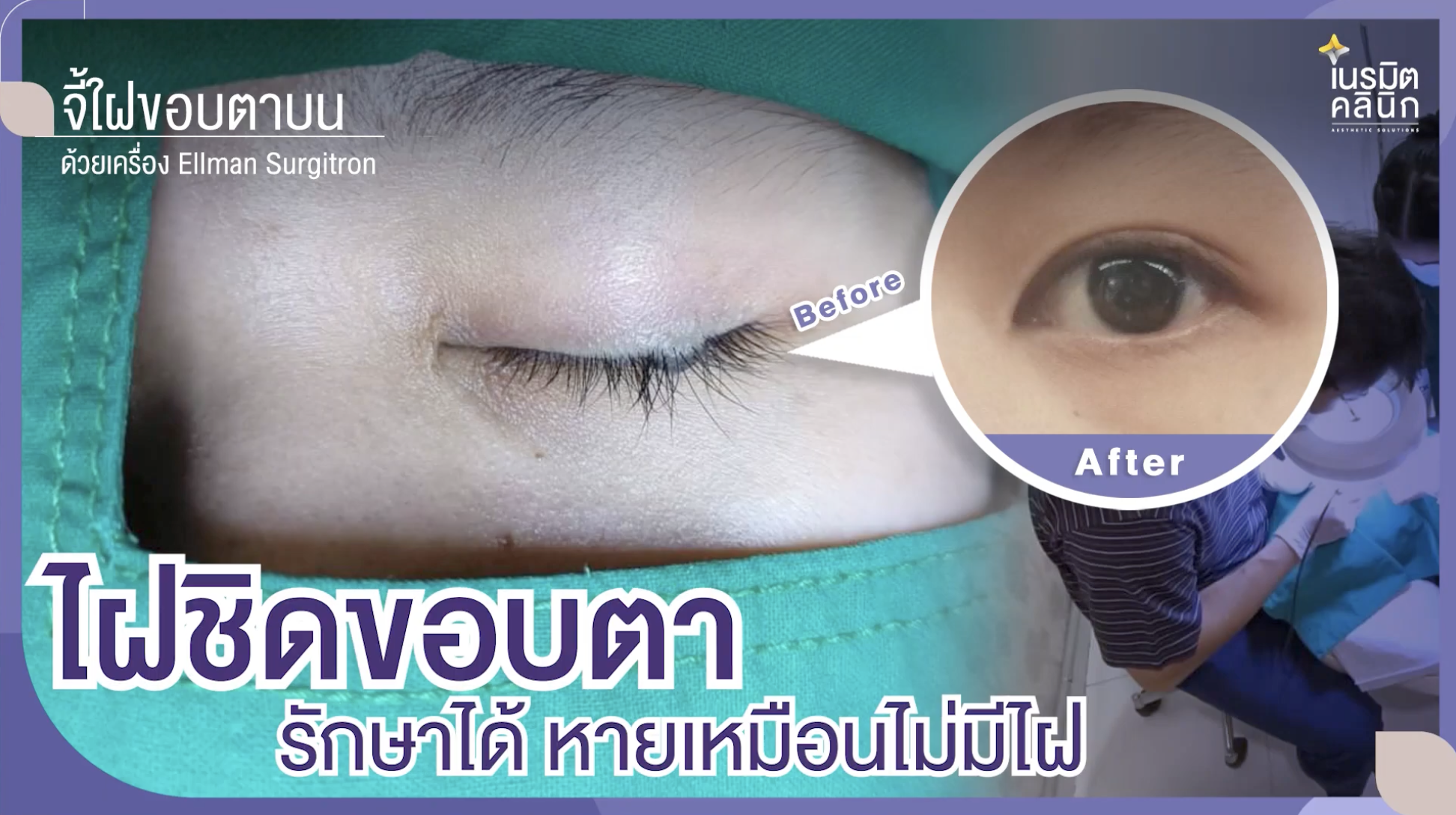 ไฝชิดขอบตา