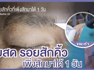ลบรอยสักคิ้ว