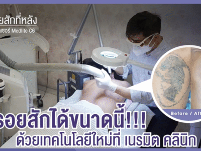 ลบรอยสักที่หลัง
