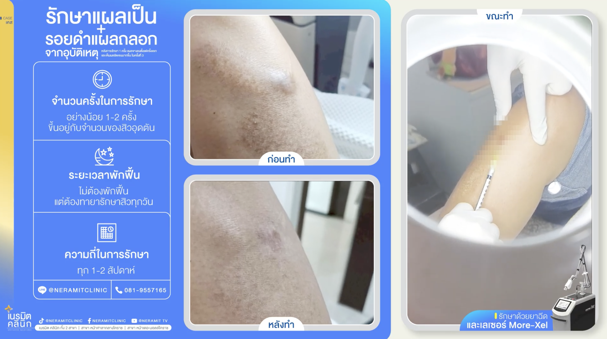 รักษาแผลเป็น