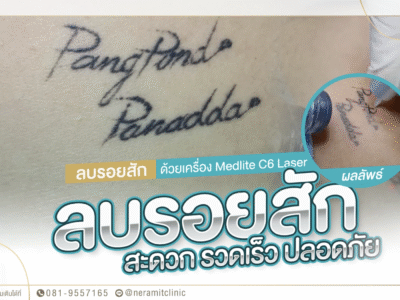ลบรอยสักชื่อ