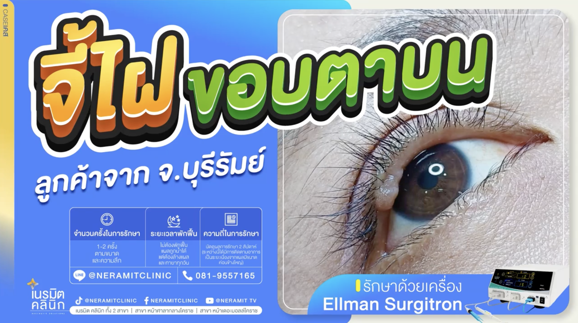 จี้ไฝขอบตาบน