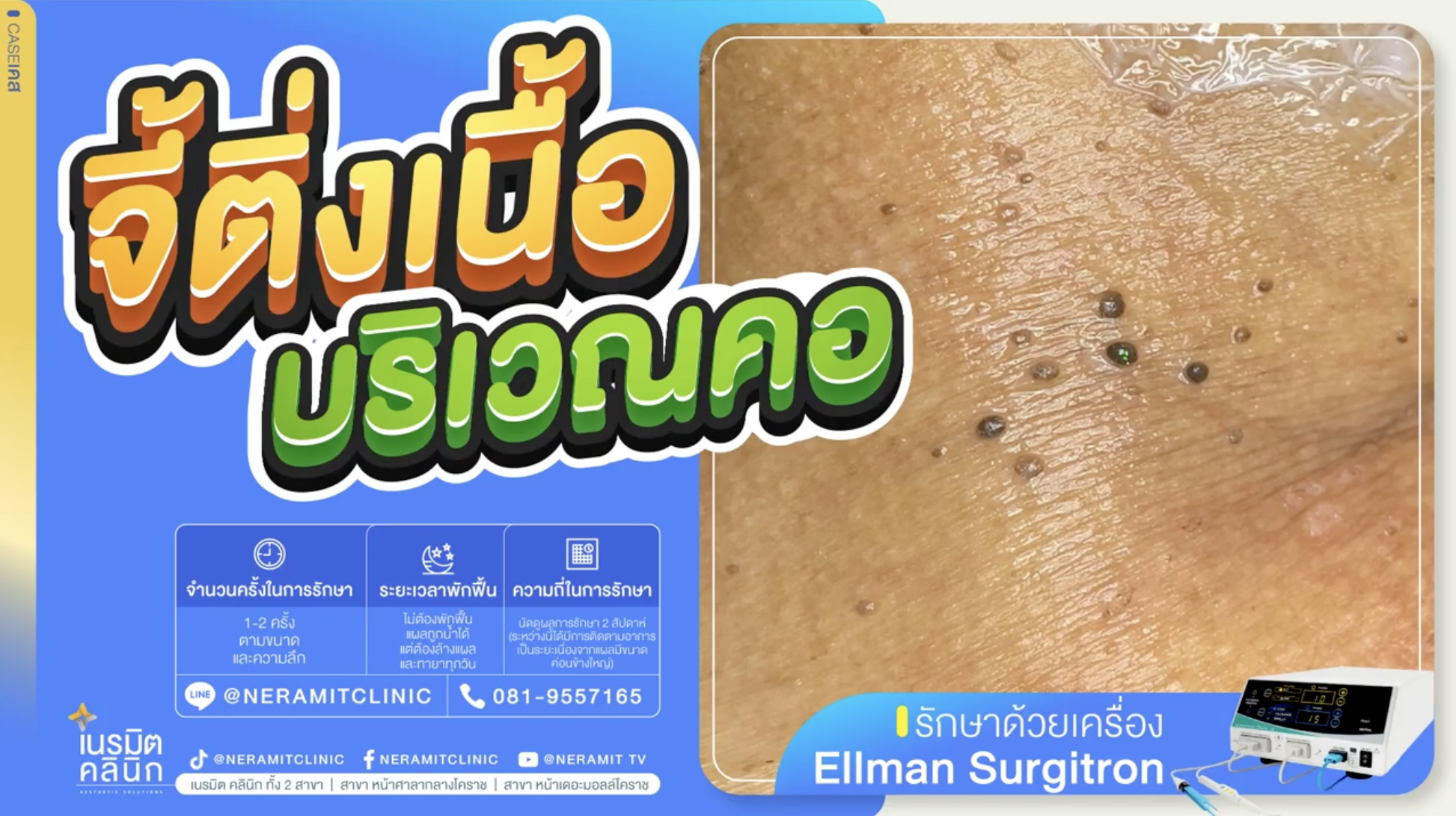 จี้ติ่งเนื้อที่คอ