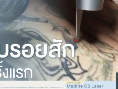 ลบรอยสักครั้งแรกจางลงแค่ไหน