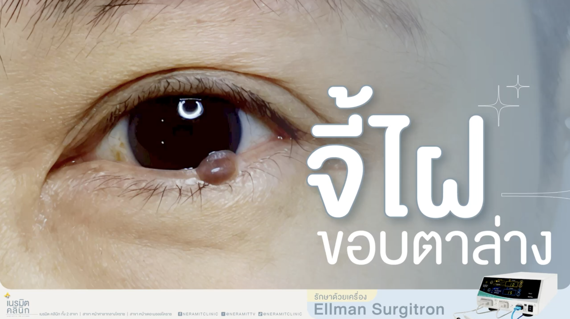 จี้ไฝขอบตา