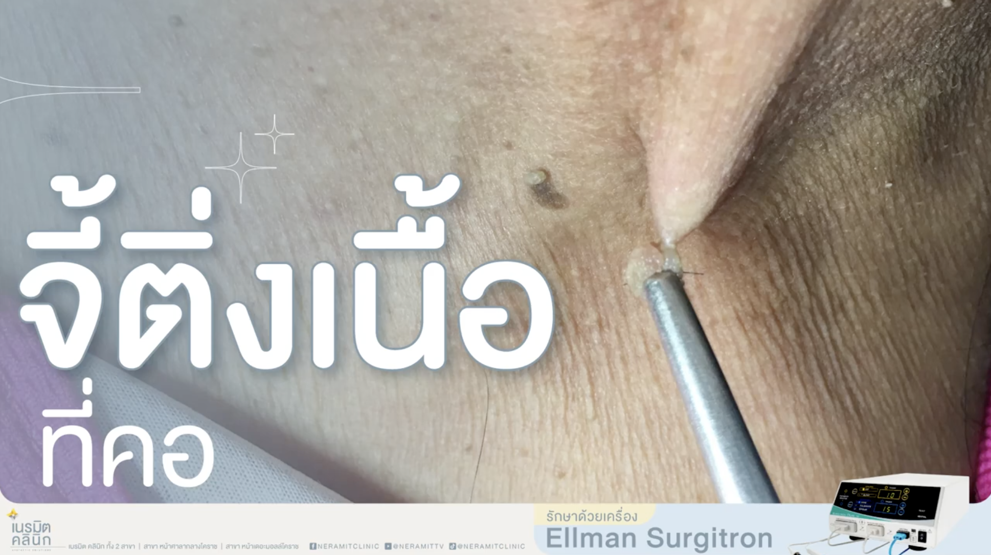 จี้ติ่งเนื้อที่คอ