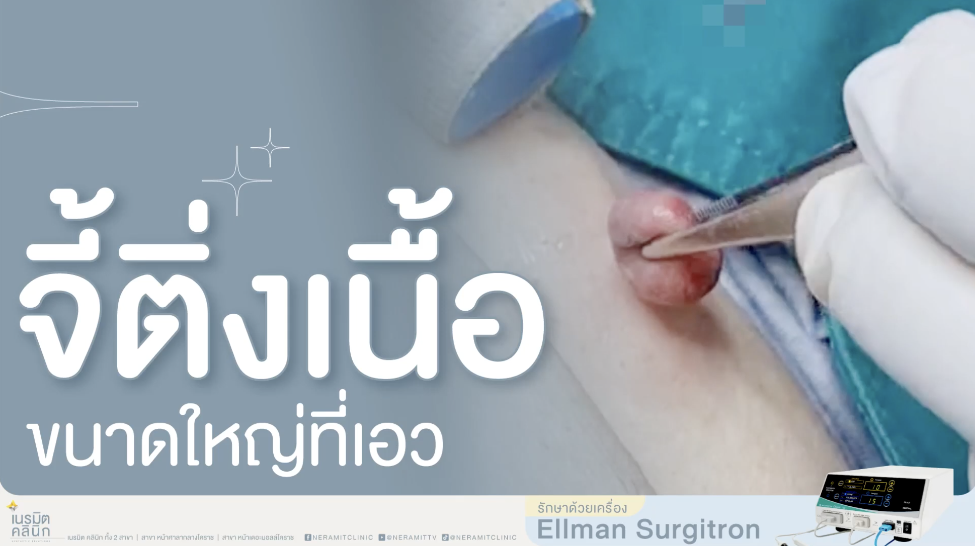 จี้ติ่งเนื้อใหญ่ที่เอว