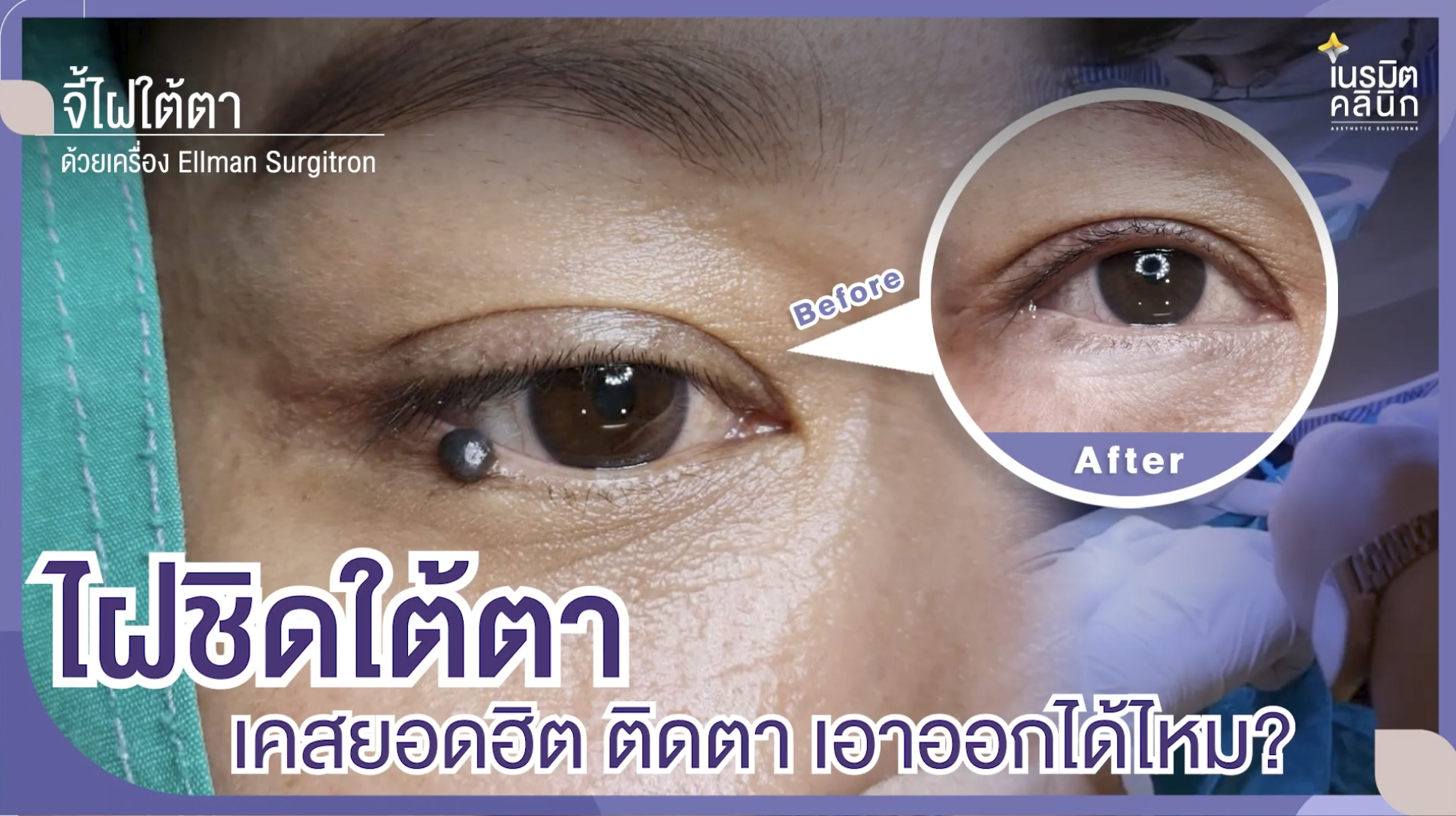 ไฝชิดใต้ตา