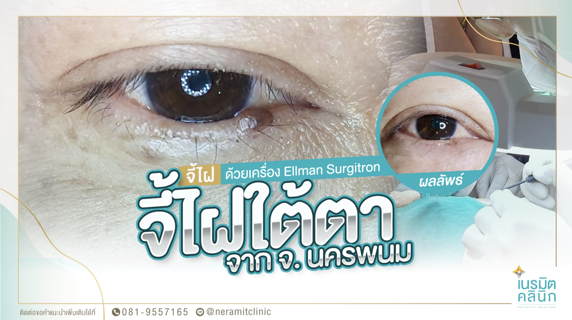 จี้ไฝใต้ตา