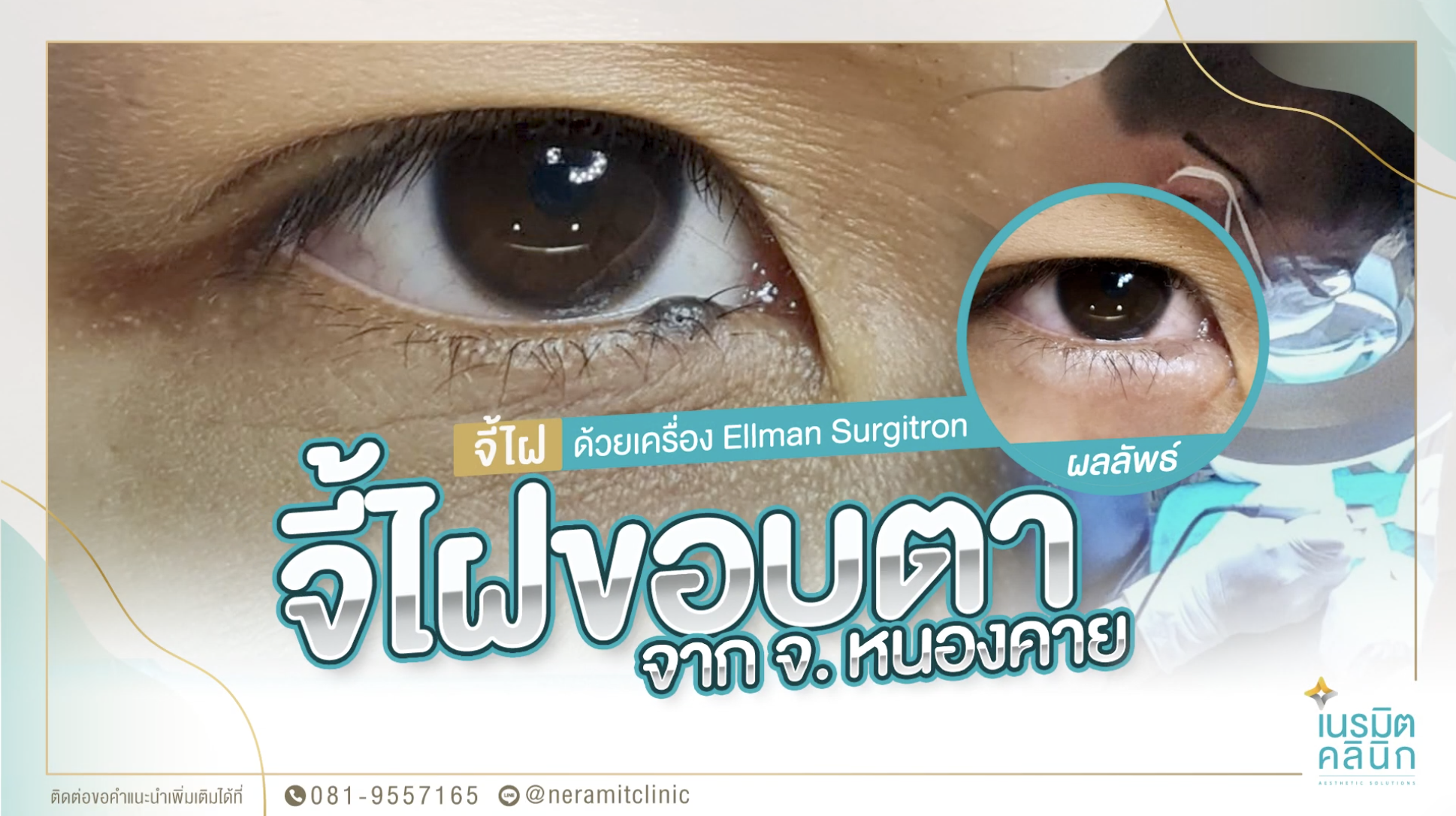 ไฝใกล้ท่อน้ำตา