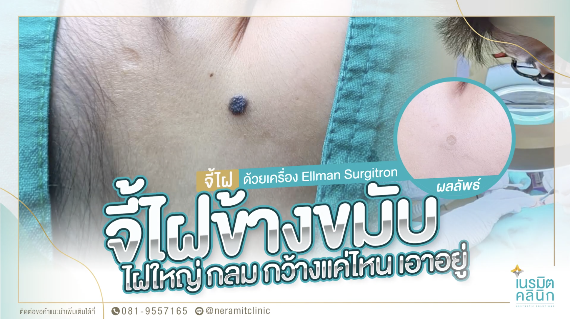 จี้ไฝข้างขมับ