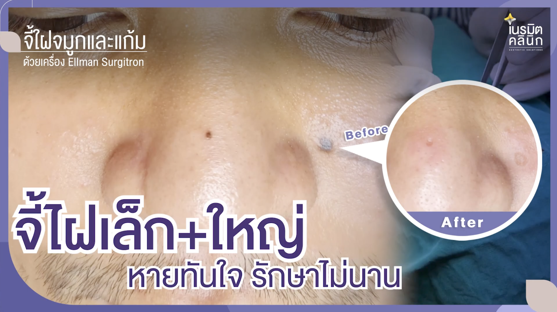 จี้ไฝเม็ดเล็กและใหญ่