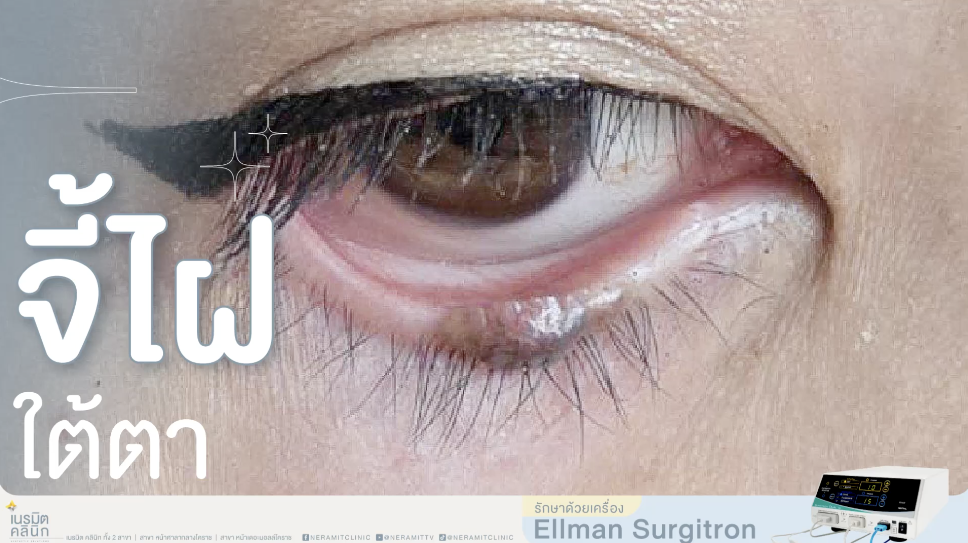 หมดปัญหาไฝขอบตา