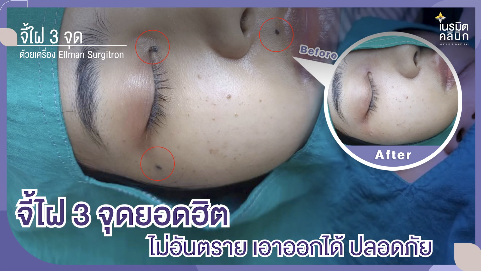 จี้ไฝ3จุดพร้อมกัน