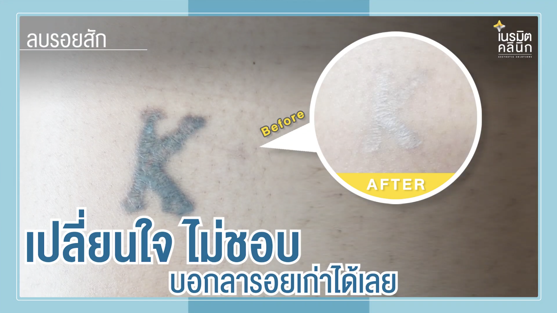 ลบรอยสัก