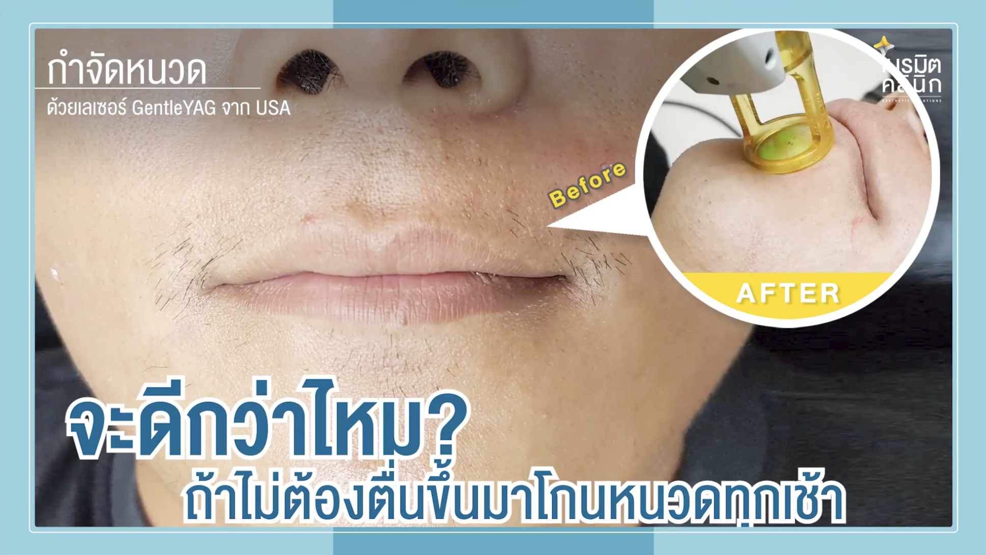 ไม่ต้องโกนหนวดทุกเช้า