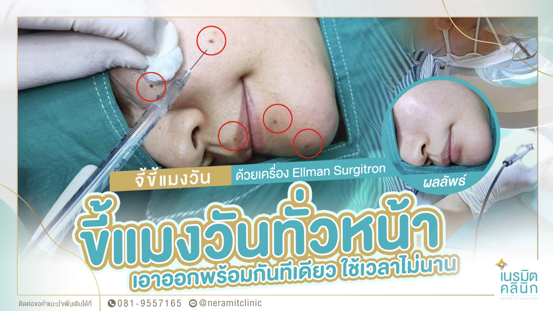 จี้ขี้แมลงวันทั่วหน้า