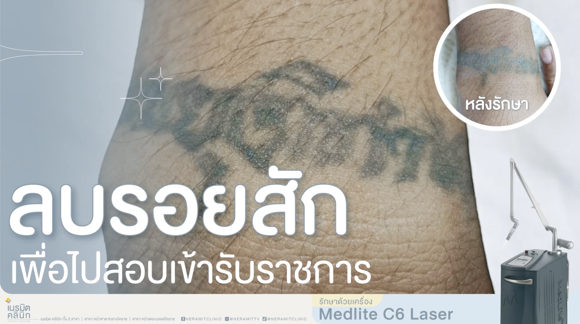 ลบรอยสักเพื่อสอบราชการ