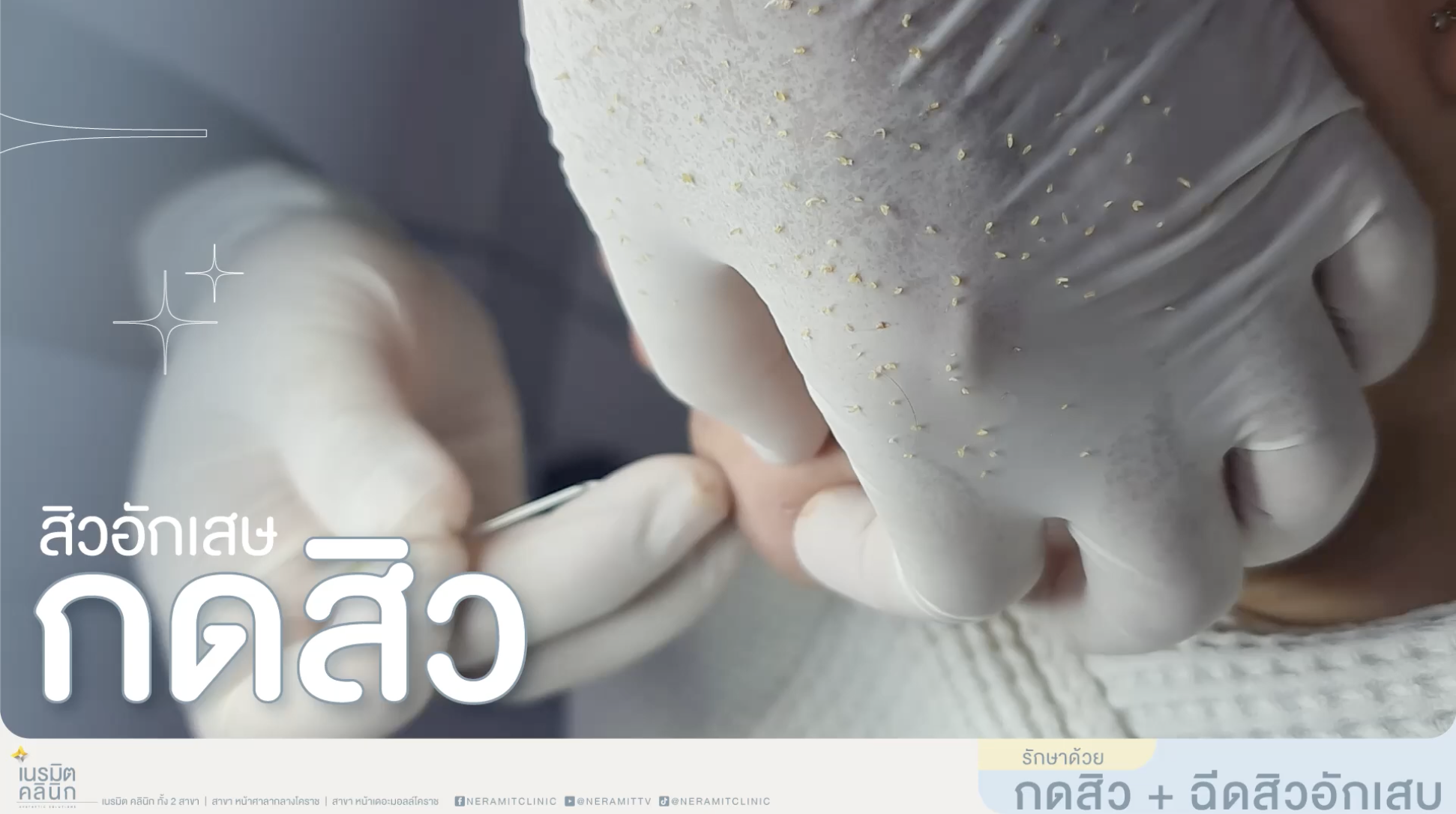 กดสิวอักเสบ