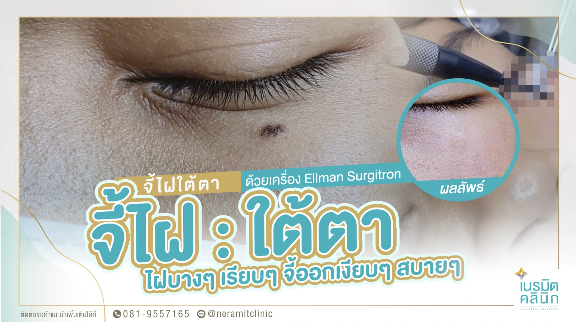 บอกลาไฝใต้ตา