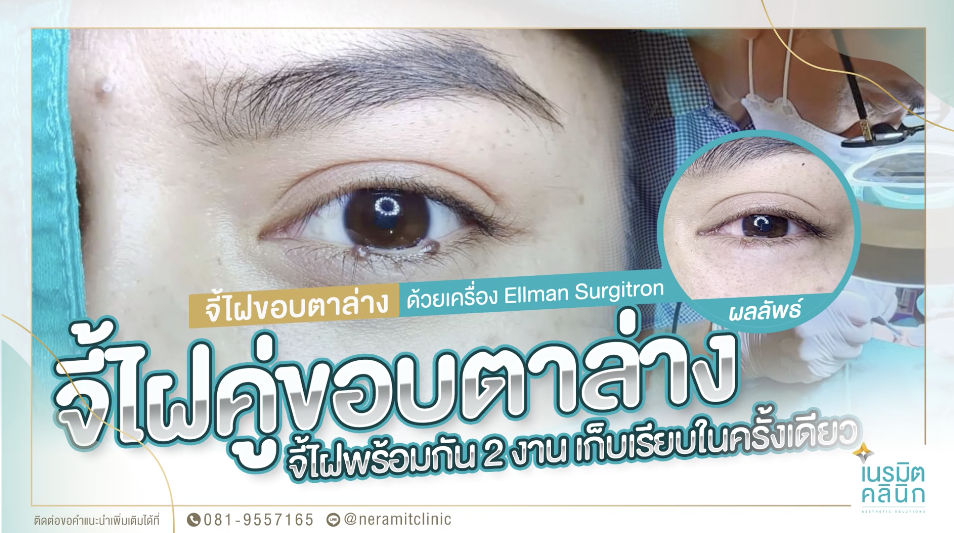 จี้ไฝใต้ตาและขอบตาล่าง