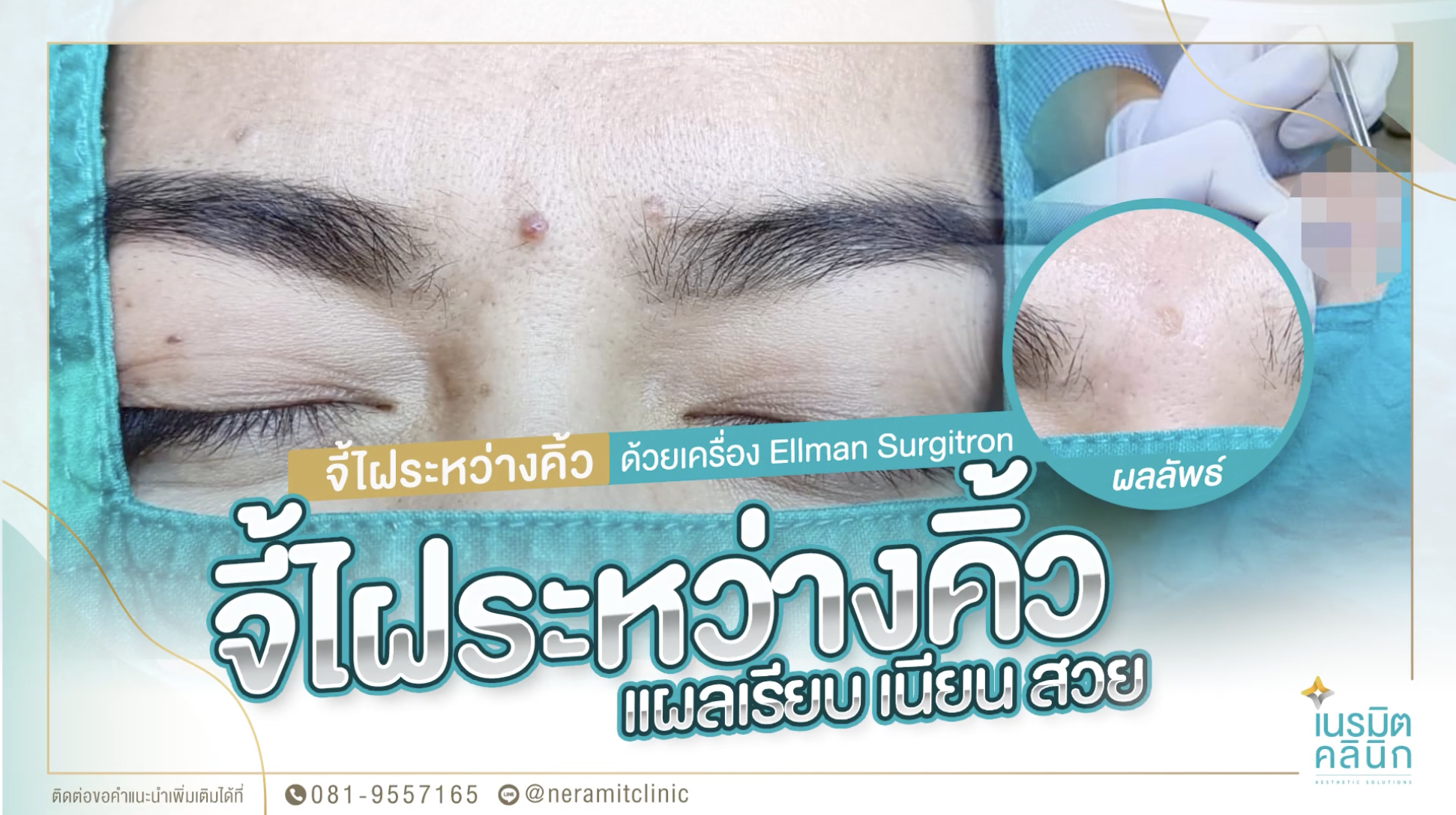 จี้ไฝระหว่างคิ้ว