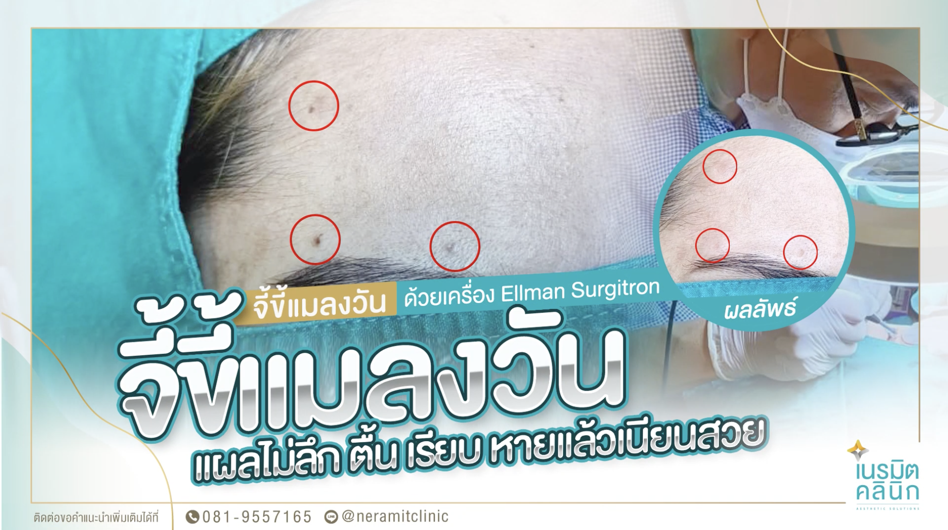 จี้ขี้แมลงวัน