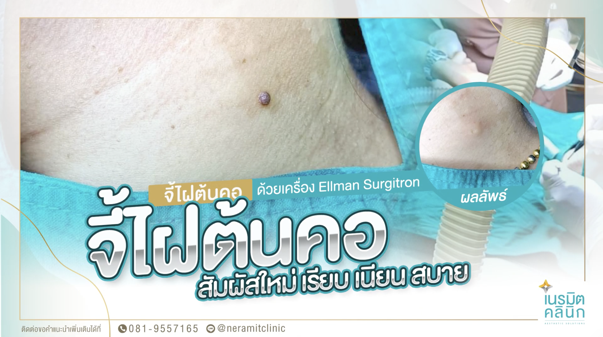 จี้ไฝต้นคอ